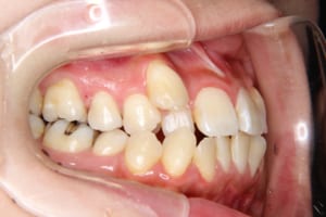 犬歯が八重歯になっています。